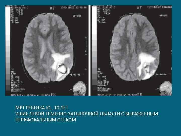 МРТ РЕБЕНКА Ю. , 10 ЛЕТ. УШИБ ЛЕВОЙ ТЕМЕННО-ЗАТЫЛОЧНОЙ ОБЛАСТИ С ВЫРАЖЕННЫМ ПЕРИФОКАЛЬНЫМ ОТЕКОМ
