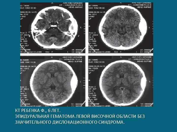 КТ РЕБЕНКА Ф. , 6 ЛЕТ. ЭПИДУРАЛЬНАЯ ГЕМАТОМА ЛЕВОЙ ВИСОЧНОЙ ОБЛАСТИ БЕЗ ЗНАЧИТЕЛЬНОГО ДИСЛОКАЦИОННОГО