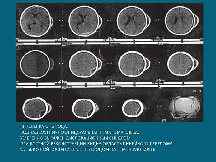 КТ РЕБЕНКА О. , 2 ГОДА. ПОДНАДКОСТНИЧНО-ЭПИДУРАЛЬНАЯ ГЕМАТОМА СЛЕВА. УМЕРЕННО ВЫРАЖЕН ДИСЛОКАЦИОННЫЙ СИНДРОМ ПРИ