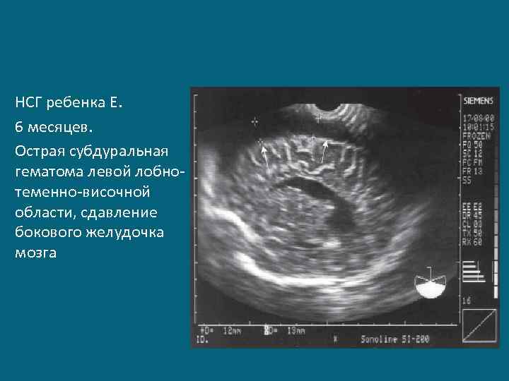 НСГ ребенка Е. 6 месяцев. Острая субдуральная гематома левой лобнотеменно-височной области, сдавление бокового желудочка