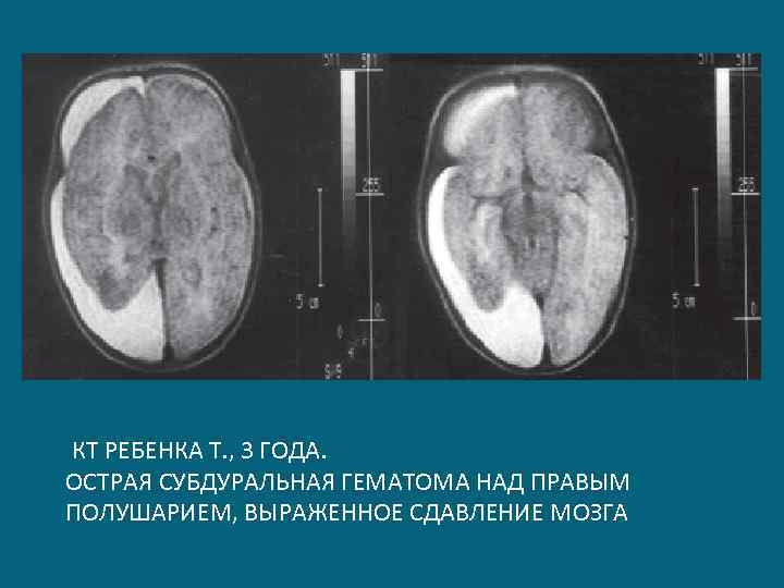  КТ РЕБЕНКА Т. , 3 ГОДА. ОСТРАЯ СУБДУРАЛЬНАЯ ГЕМАТОМА НАД ПРАВЫМ ПОЛУШАРИЕМ, ВЫРАЖЕННОЕ