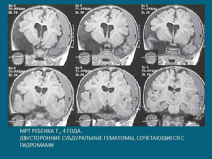 МРТ РЕБЕНКА Т. , 4 ГОДА. ДВУСТОРОННИЕ СУБДУРАЛЬНЫЕ ГЕМАТОМЫ, СОЧЕТАЮЩИЕСЯ С ГИДРОМАМИ 