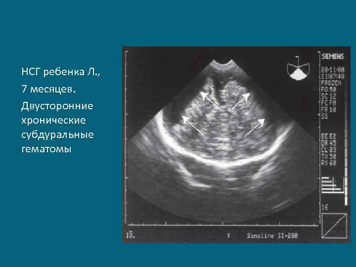НСГ ребенка Л. , 7 месяцев. Двусторонние хронические субдуральные гематомы 