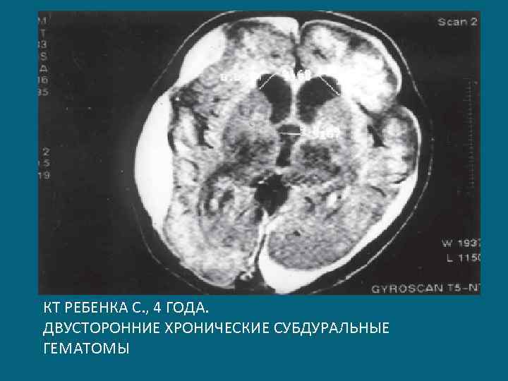КТ РЕБЕНКА С. , 4 ГОДА. ДВУСТОРОННИЕ ХРОНИЧЕСКИЕ СУБДУРАЛЬНЫЕ ГЕМАТОМЫ 