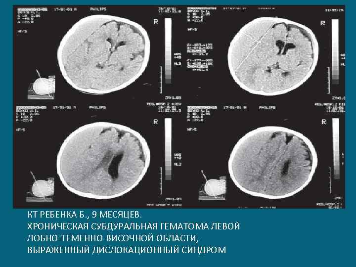 КТ РЕБЕНКА Б. , 9 МЕСЯЦЕВ. ХРОНИЧЕСКАЯ СУБДУРАЛЬНАЯ ГЕМАТОМА ЛЕВОЙ ЛОБНО-ТЕМЕННО-ВИСОЧНОЙ ОБЛАСТИ, ВЫРАЖЕННЫЙ ДИСЛОКАЦИОННЫЙ