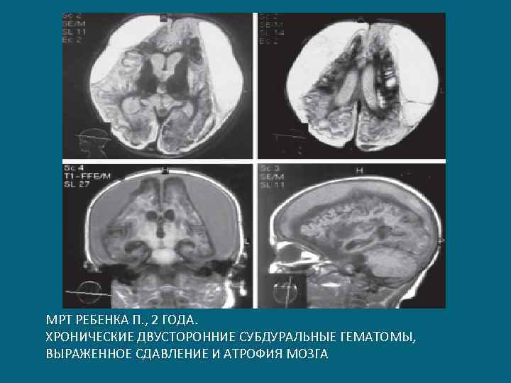 МРТ РЕБЕНКА П. , 2 ГОДА. ХРОНИЧЕСКИЕ ДВУСТОРОННИЕ СУБДУРАЛЬНЫЕ ГЕМАТОМЫ, ВЫРАЖЕННОЕ СДАВЛЕНИЕ И АТРОФИЯ