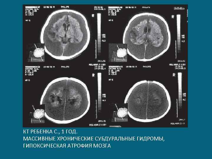 КТ РЕБЕНКА С. , 1 ГОД. МАССИВНЫЕ ХРОНИЧЕСКИЕ СУБДУРАЛЬНЫЕ ГИДРОМЫ, ГИПОКСИЧЕСКАЯ АТРОФИЯ МОЗГА 