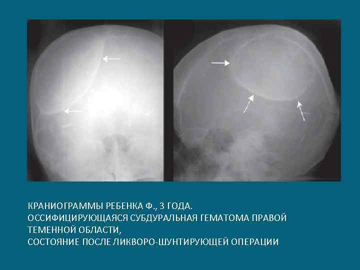 КРАНИОГРАММЫ РЕБЕНКА Ф. , 3 ГОДА. ОССИФИЦИРУЮЩАЯСЯ СУБДУРАЛЬНАЯ ГЕМАТОМА ПРАВОЙ ТЕМЕННОЙ ОБЛАСТИ, СОСТОЯНИЕ ПОСЛЕ