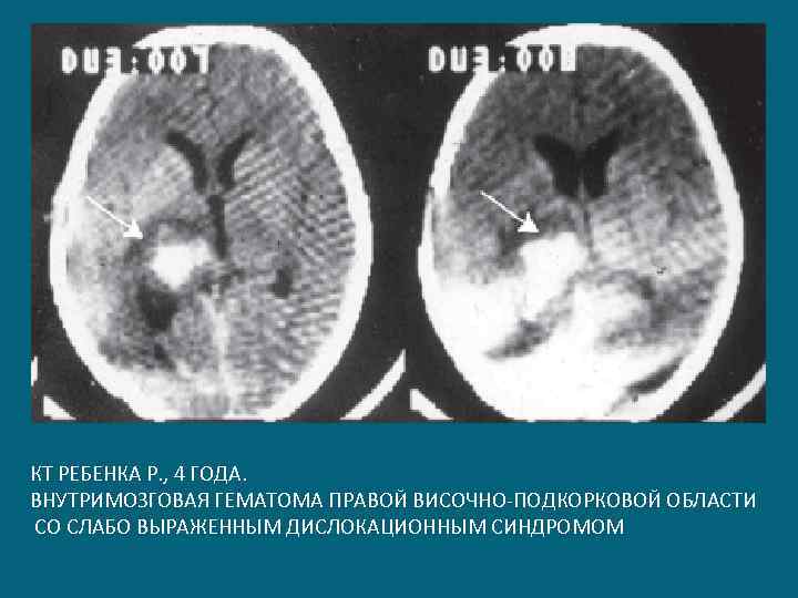 КТ РЕБЕНКА Р. , 4 ГОДА. ВНУТРИМОЗГОВАЯ ГЕМАТОМА ПРАВОЙ ВИСОЧНО-ПОДКОРКОВОЙ ОБЛАСТИ СО СЛАБО ВЫРАЖЕННЫМ