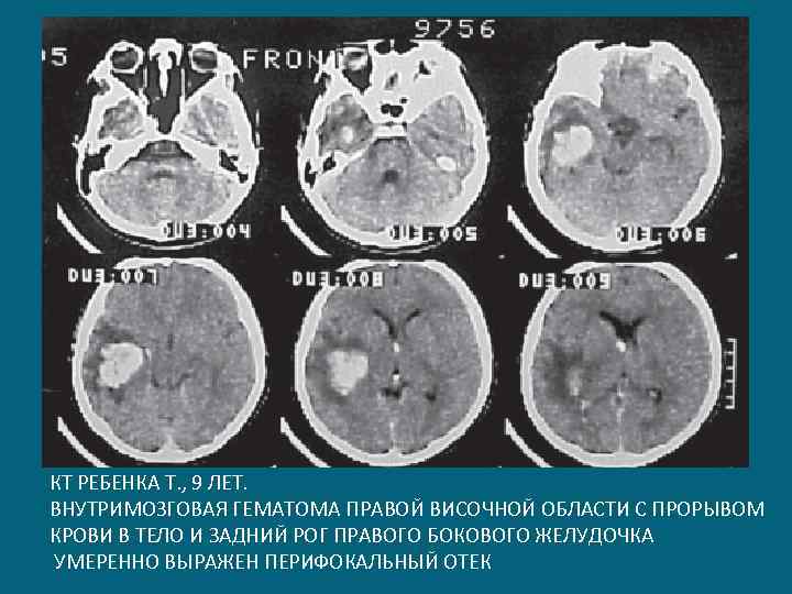 Внутримозговая гематома кт. Эволюция внутримозговой гематомы на мрт.