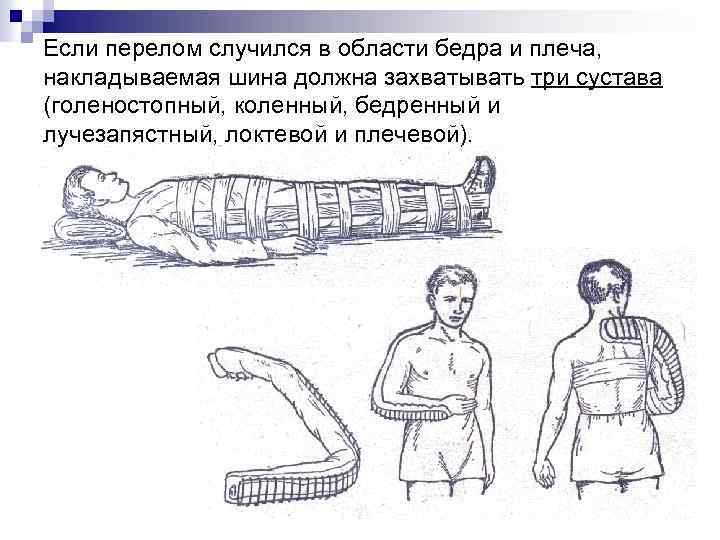 При закрытом переломе бедра необходимо тест