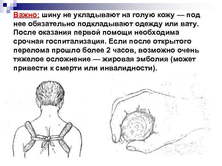 Важно: шину не укладывают на голую кожу — под нее обязательно подкладывают одежду или