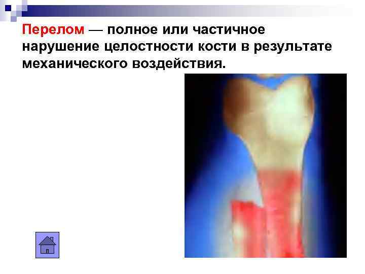 Перелом — полное или частичное нарушение целостности кости в результате механического воздействия. 