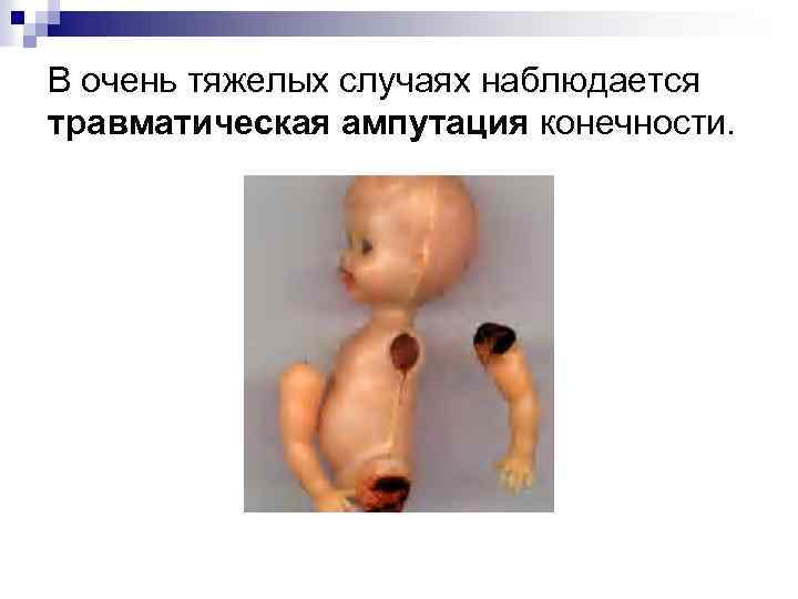 В очень тяжелых случаях наблюдается травматическая ампутация конечности. 