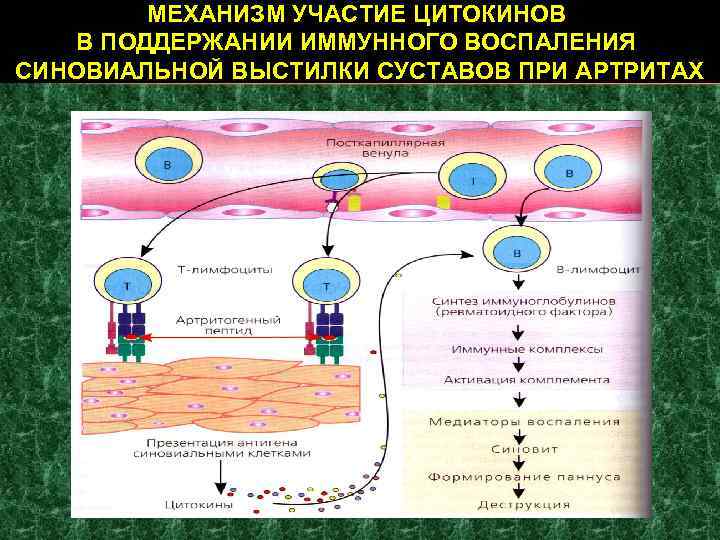 МЕХАНИЗМ УЧАСТИЕ ЦИТОКИНОВ В ПОДДЕРЖАНИИ ИММУННОГО ВОСПАЛЕНИЯ СИНОВИАЛЬНОЙ ВЫСТИЛКИ СУСТАВОВ ПРИ АРТРИТАХ 