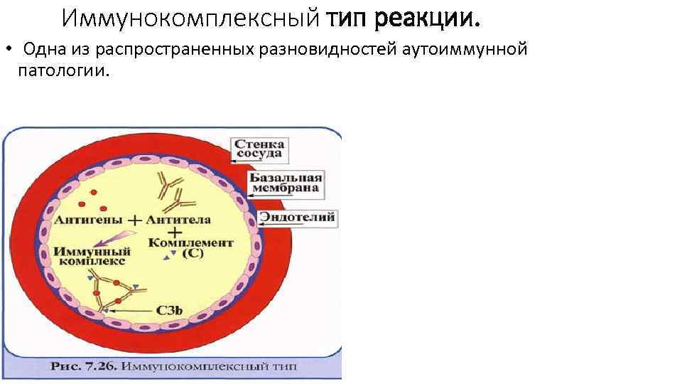 Иммунокомплексный тип реакции. • Одна из распространенных разновидностей аутоиммунной патологии. 