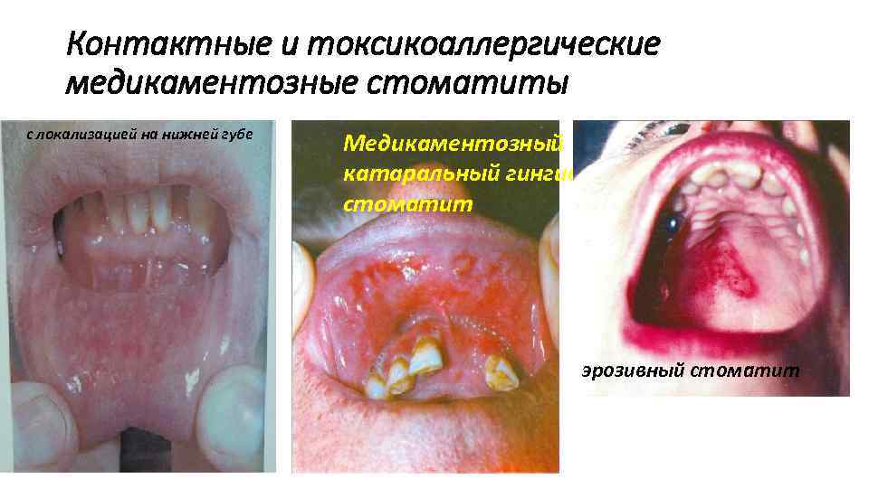 Контактные и токсикоаллергические медикаментозные стоматиты с локализацией на нижней губе Медикаментозный катаральный гингивостоматит эрозивный