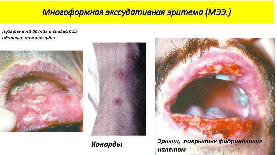 Многоформная экссудативная эритема (МЭЭ. ) Пузырьки на деснах и слизистой оболочке нижней губы Кокарды