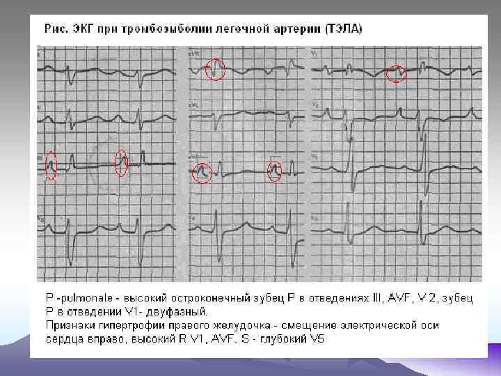 Патология экг картинки