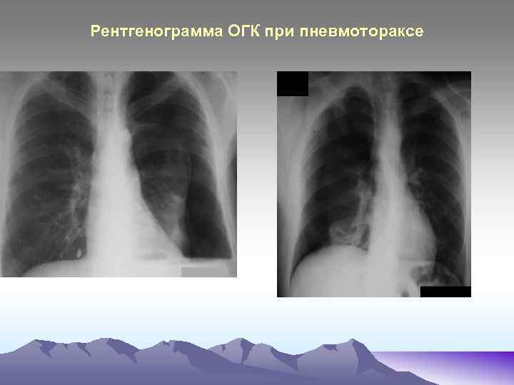 Рентгенограмма ОГК при пневмотораксе 