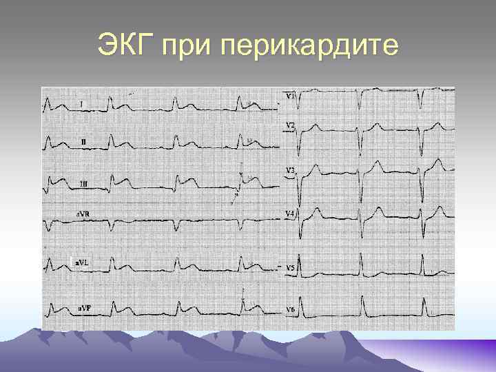 ЭКГ при перикардите 