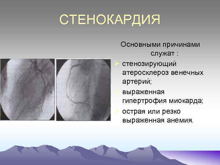 СТЕНОКАРДИЯ Основными причинами служат : Ø стенозирующий атеросклероз венечных артерий; Ø выраженная гипертрофия миокарда;