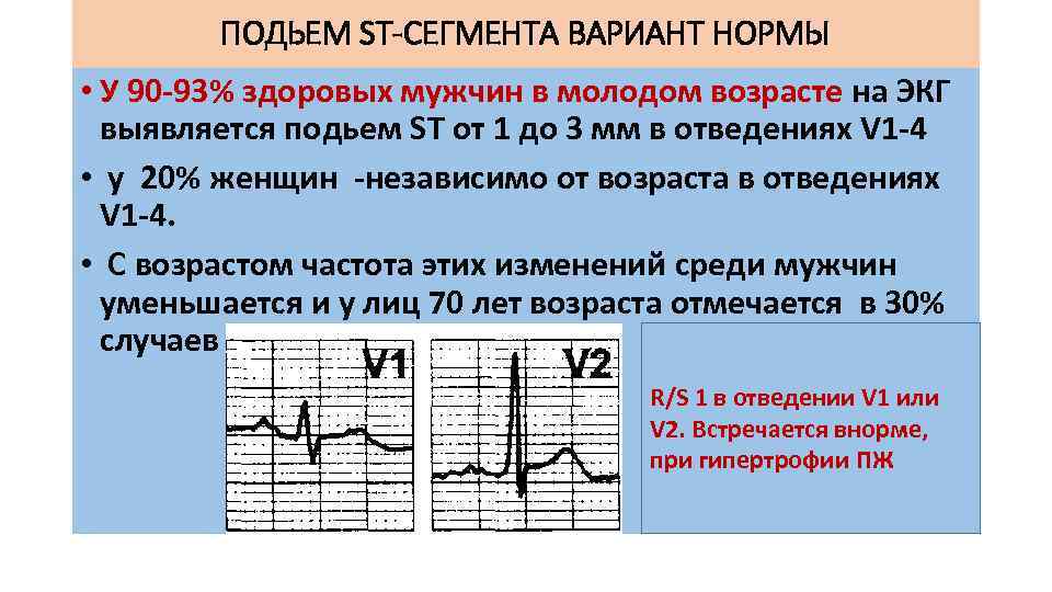 ПОДЬЕМ ST-СЕГМЕНТА ВАРИАНТ НОРМЫ • У 90 -93% здоровых мужчин в молодом возрасте на