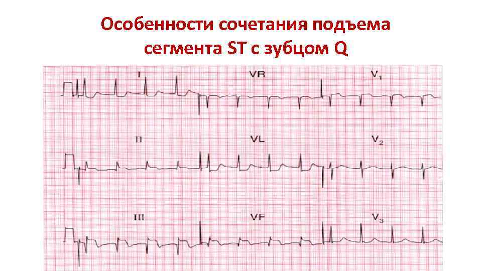 Особенности сочетания подъема сегмента ST с зубцом Q 