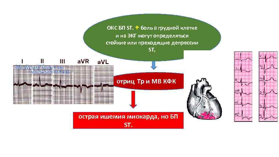 ОКС БП ST. + боль в грудной клетке и на ЭКГ могут определяться стойкие