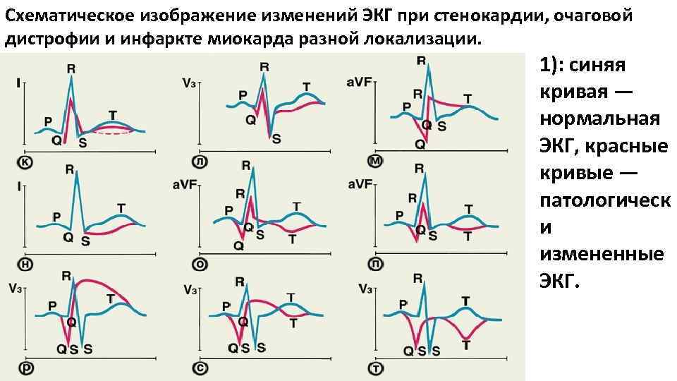 Схематическое изображение изменений ЭКГ при стенокардии, очаговой дистрофии и инфаркте миокарда разной локализации. 1):