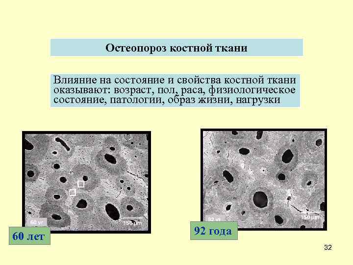 Остеопороз костной ткани Влияние на состояние и свойства костной ткани оказывают: возраст, пол, раса,