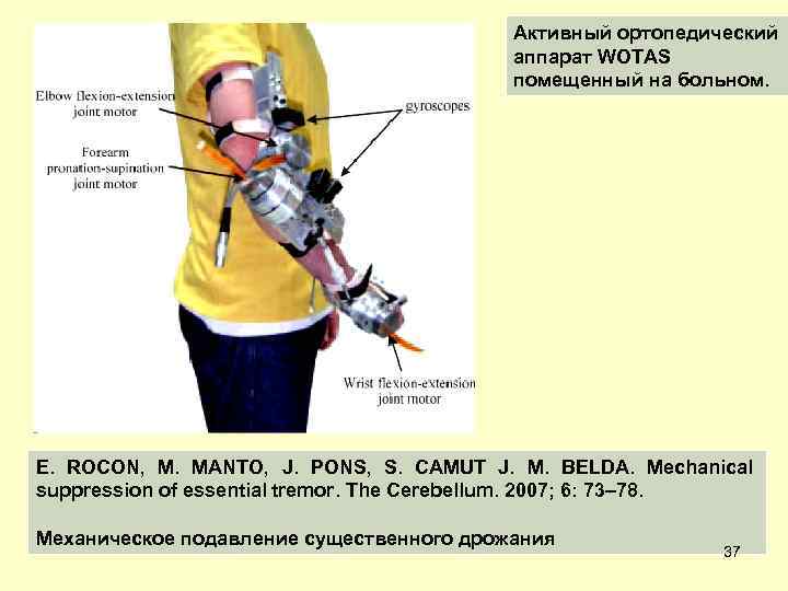 Активный ортопедический аппарат WOTAS помещенный на больном. E. ROCON, M. MANTO, J. PONS, S.