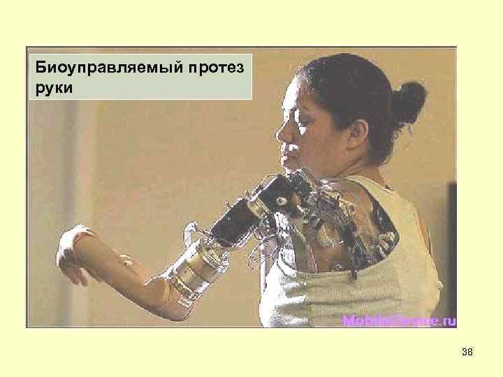 Биоуправляемый протез руки 38 