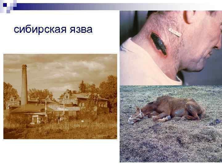 сибирская язва 34 