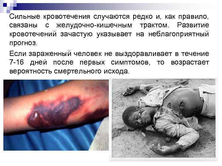 Сильные кровотечения случаются редко и, как правило, связаны с желудочно-кишечным трактом. Развитие кровотечений зачастую