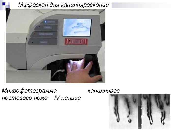 Микроскоп для капилляроскопии Микрофотограмма ногтевого ложа IV пальца капилляров 40 