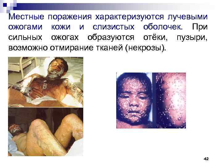 Местные поражения характеризуются лучевыми ожогами кожи и слизистых оболочек. При сильных ожогах образуются отёки,