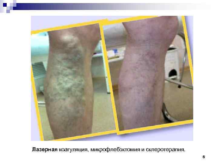 Лазерная коагуляция, микрофлебэктомия и склеротерапия. 6 