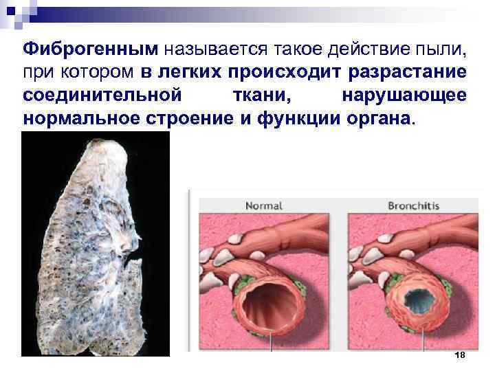 Фиброгенным называется такое действие пыли, при котором в легких происходит разрастание соединительной ткани, нарушающее