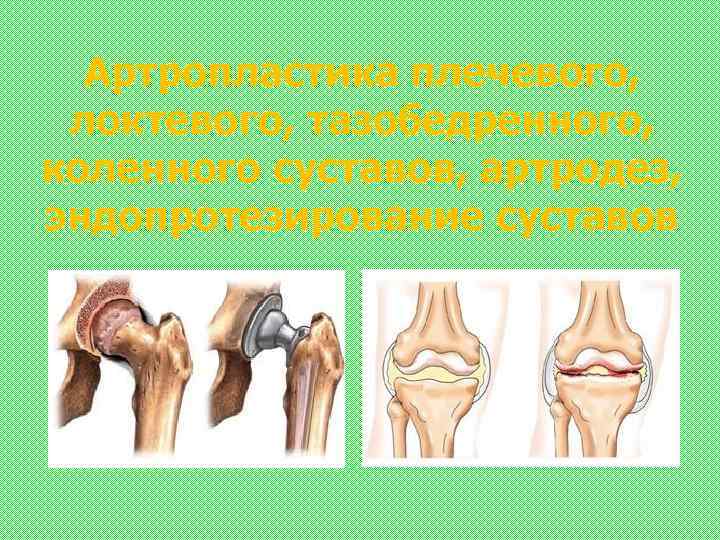 Артропластика плечевого, локтевого, тазобедренного, коленного суставов, артродез, эндопротезирование суставов 