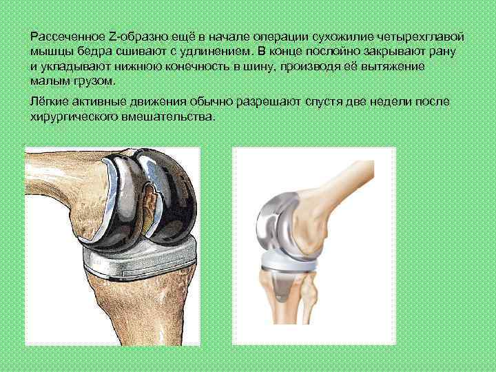 Рассеченное Z-образно ещё в начале операции сухожилие четырехглавой мышцы бедра сшивают с удлинением. В