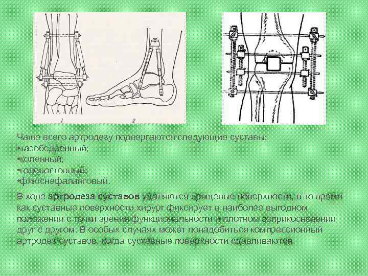 Чаще всего артродезу подвергаются следующие суставы: • тазобедренный; • коленный; • голеностопный; • флюснефаланговый.