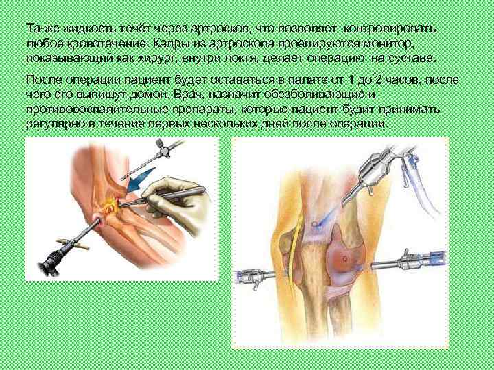 Та-же жидкость течёт через артроскоп, что позволяет контролировать любое кровотечение. Кадры из артроскопа проецируются
