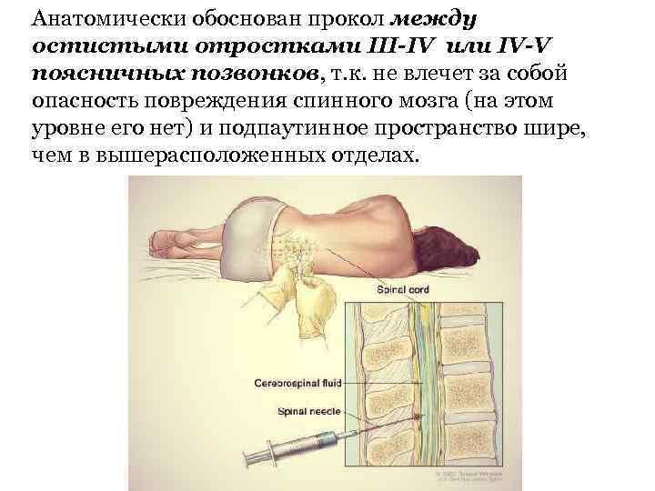 Анатомически обоснован прокол между остистыми отростками III-IV или IV-V поясничных позвонков, т. к. не