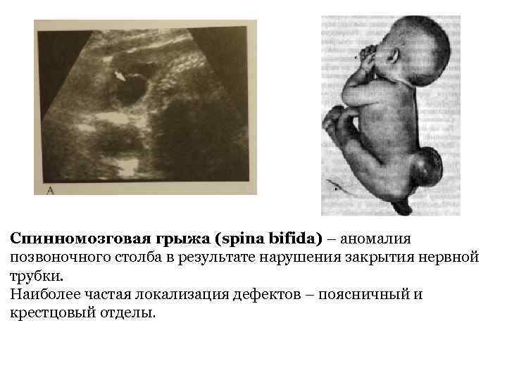 Спинномозговая грыжа (spina bifida) – аномалия позвоночного столба в результате нарушения закрытия нервной трубки.