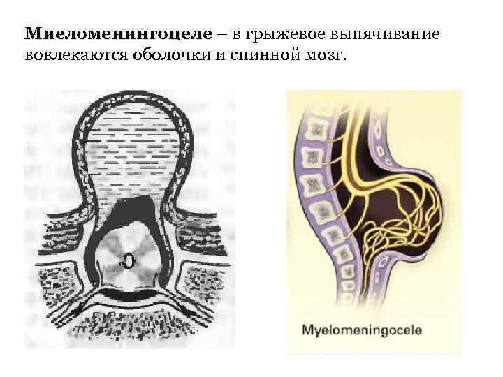 Миеломенингоцеле – в грыжевое выпячивание Миеломенингоцеле вовлекаются оболочки и спинной мозг. 