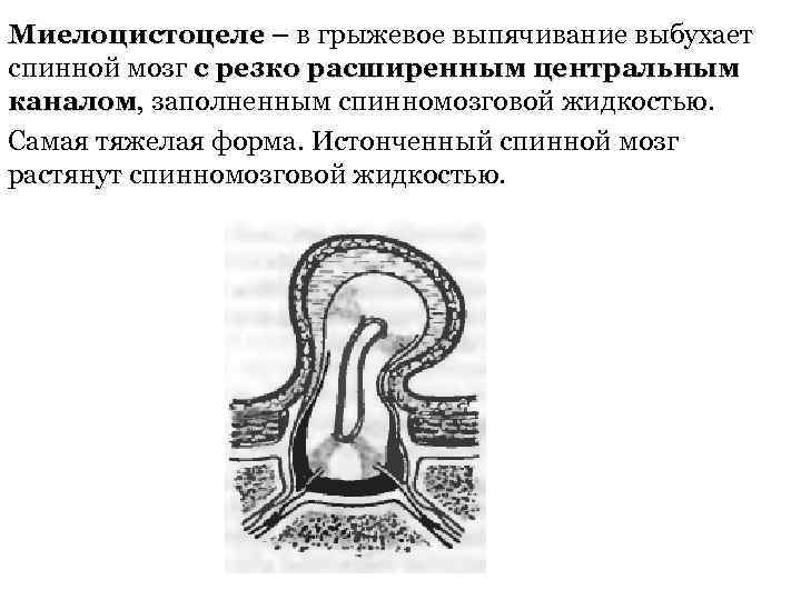 Миелоцистоцеле – в грыжевое выпячивание выбухает Миелоцистоцеле спинной мозг с резко расширенным центральным каналом,