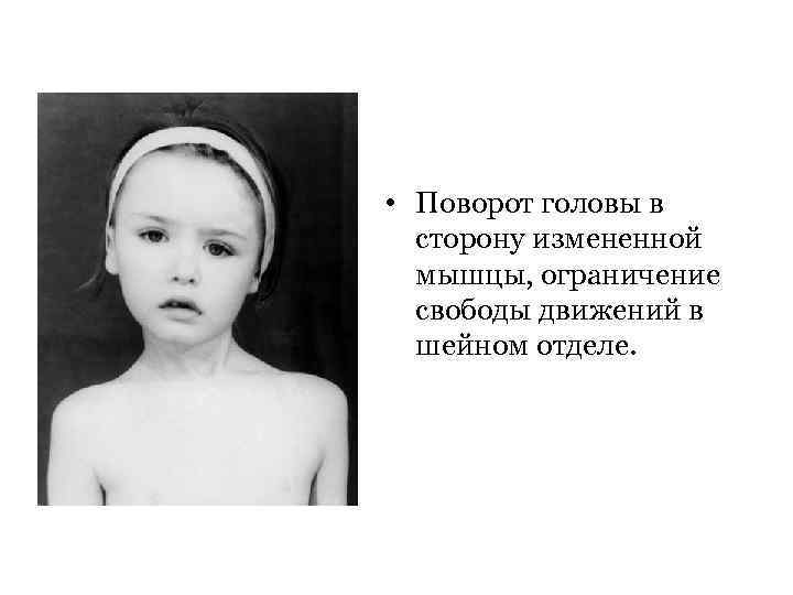  • Поворот головы в сторону измененной мышцы, ограничение свободы движений в шейном отделе.