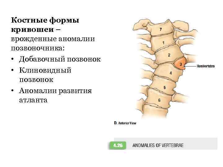 Костные формы кривошеи – врожденные аномалии позвоночника: • Добавочный позвонок • Клиновидный позвонок •