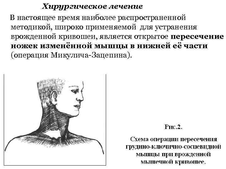 Хирургическое лечение В настоящее время наиболее распространенной методикой, широко применяемой для устранения врожденной кривошеи,